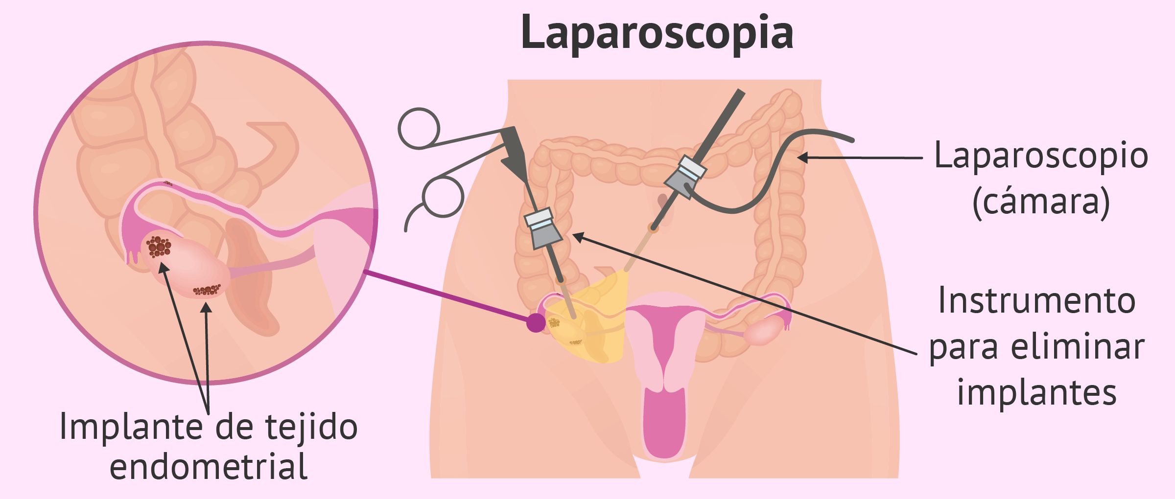 diagnostico_endometriosis Laparoscopia endometriosis